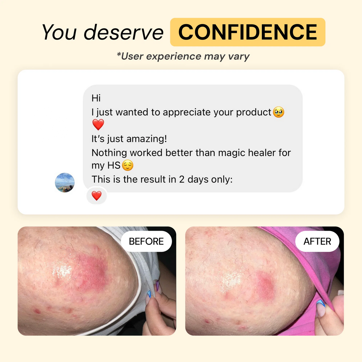 CalmVera – Natural Skin Soothing Balm for Irritation, Chafing & Friction-Prone Skin