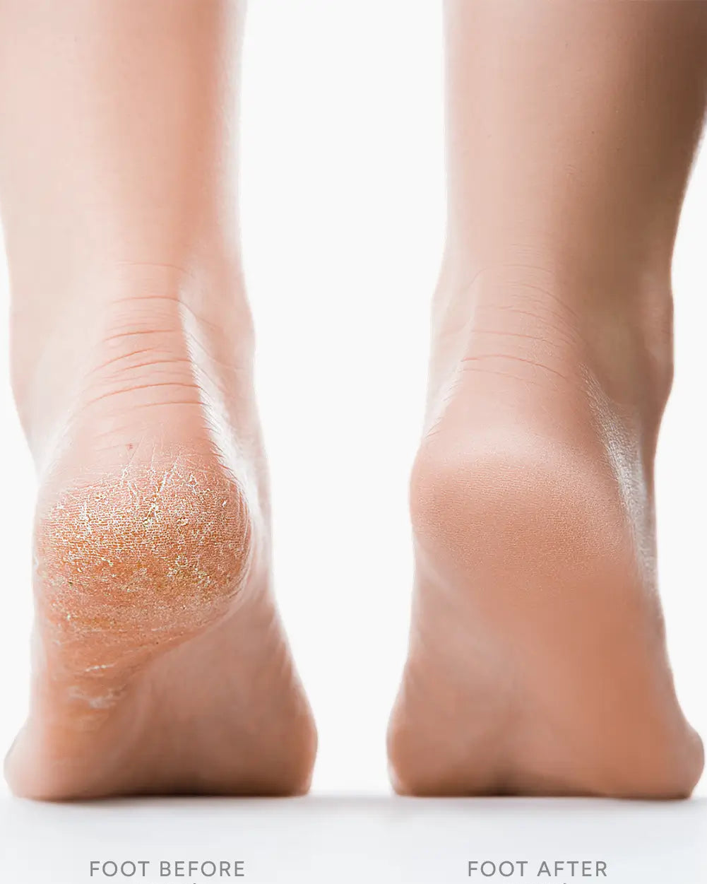 SilkStep™ Pro Electric Callus Remover